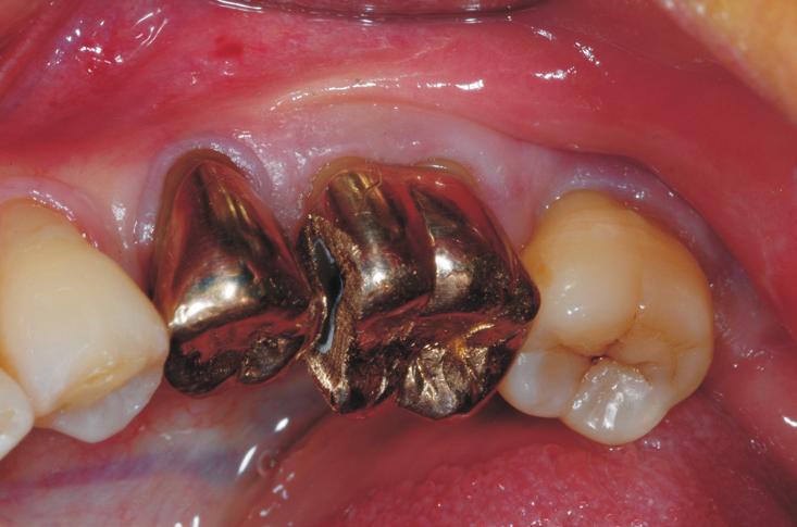 It was planned to conduct implant placement immediately after tooth extraction.