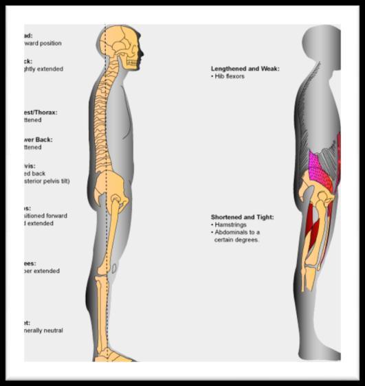 편평등자세 (flat-back posture) (1) 해부학적변화 1요추의굴곡 2골반의후방경사 3고관절이신전 (2) 단축된위치에있는근육 1전복부근 2고관절신근 (3)