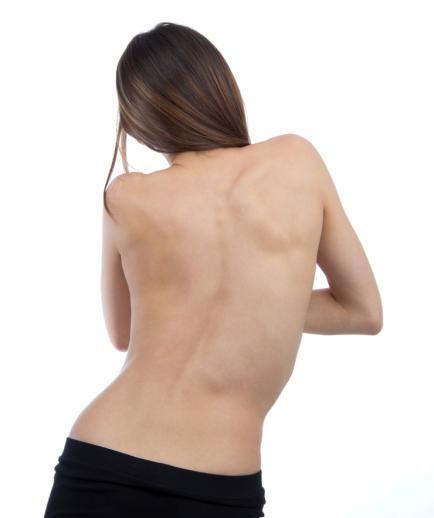 흉요추측만증 (scoliosis) (1) 측만증환자의치료적운동 1 비대칭성근력운동 2 균형적인운동을통해전신운동성증진 3 견고하여진연부조직을위한조작 4 근육의지구력을위한운동 5 의식적인자세교정 (2) 측만증관련