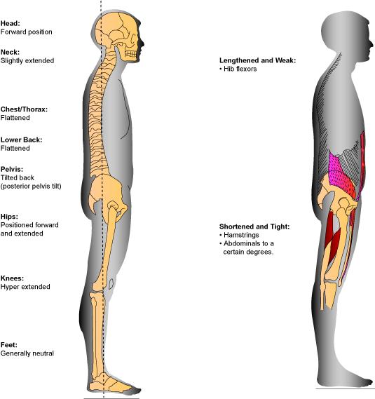 편평등자세 (flat-back posture) (1) 해부학적변화 1 요추의굴곡 2 골반의후방경사 3