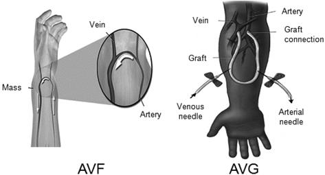 eptfe 인공혈관에대한파클리탁셀의코팅및방출거동 327 Figure 1. Arteriovenous fistula (AVF) and arteriovenous graft (AVG) to secure hemodialysis vascular access. 사용된다 (Figure 1).