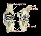 인공비구컵골반의비구부에결합내부에인공비구라이너가삽입 대퇴부부품 경골삽입물근위경골치환물