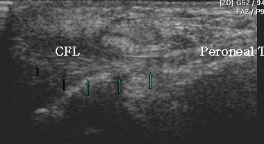 정상 CFL 스캔. CFL 위로태극모양의종아리힘줄이관찰된다. Morton 씨신경종 (Morton's neuroma) 앞쪽발에서만발생하는또다른특징적인병변은 Morton씨신경종이다. Morton씨신경종은발바닥발가락신경의섬유성퇴행이원인이다. 많은경우에서발허리뼈 ( 중족골 ) 사이윤활낭염과관련이있다.