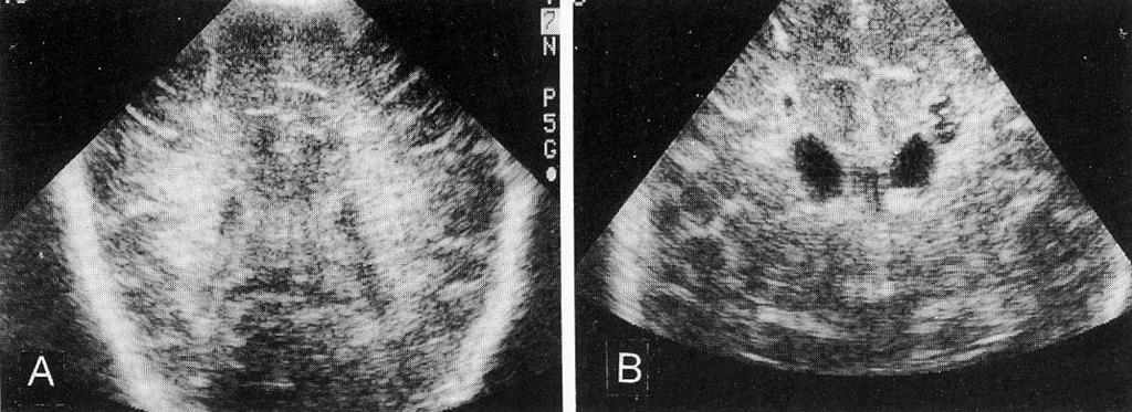 낭종성뇌실주위백질연화증발생의임상양상과신경학적예후 Fig.1.Brainultrasonographicfindingsofperiventricularleukomalaciainthecoronalplane.A)Note the bilateralincreased periventricular echogenicity.