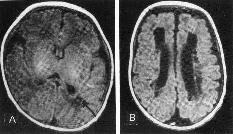 A)Notethesmallow signallesion (arow)ont1-weightimageatleftposteriortrigonalarea indicating microcysticpvl.b)notethe multiplecystic lesionslocated periventricularwhitematerindicatingextensivepvl.