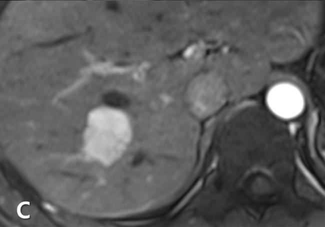 After injection of contrast media, the mass begins to show peripheral nodular contrast-enhancement in the arterial phase (B).