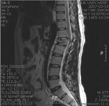 120 대한약침학회지제 11 권제 2 호 (2008 년 6 월 ) Fig.2. L1 vertebra -burst fracture with dislocation of fragment and kyphosis at fracture site. severe spinal stenosis due to Fig.3.