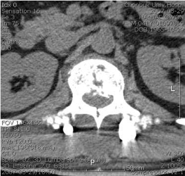 考察마미 (cauda equina) 란척수와척추간의다른성장률 때문에꼬리쪽척수신경일수록상응하는추간공에도달하기위해서는상당한거리의지주막하공간을주행하여야하므로꼬리쪽신경들이척수막없이終絲주변에모여있는것을말한다.