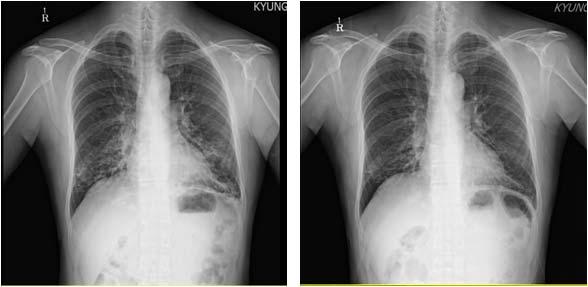 시경반하탕 ( 보험제제 ) 을통한기관지확장증환자의관리 1 례 Fig. 2. CXR PA (Lt.) 2015.4.29. (Rt.) 2018.1.4. Ⅳ. 고찰기관지확장증은만성호흡기질환으로, 기침, 객담및기관지감염등을일으키며방사선학적으로는기관지의비정상적, 영구적확장을특징으로한다.