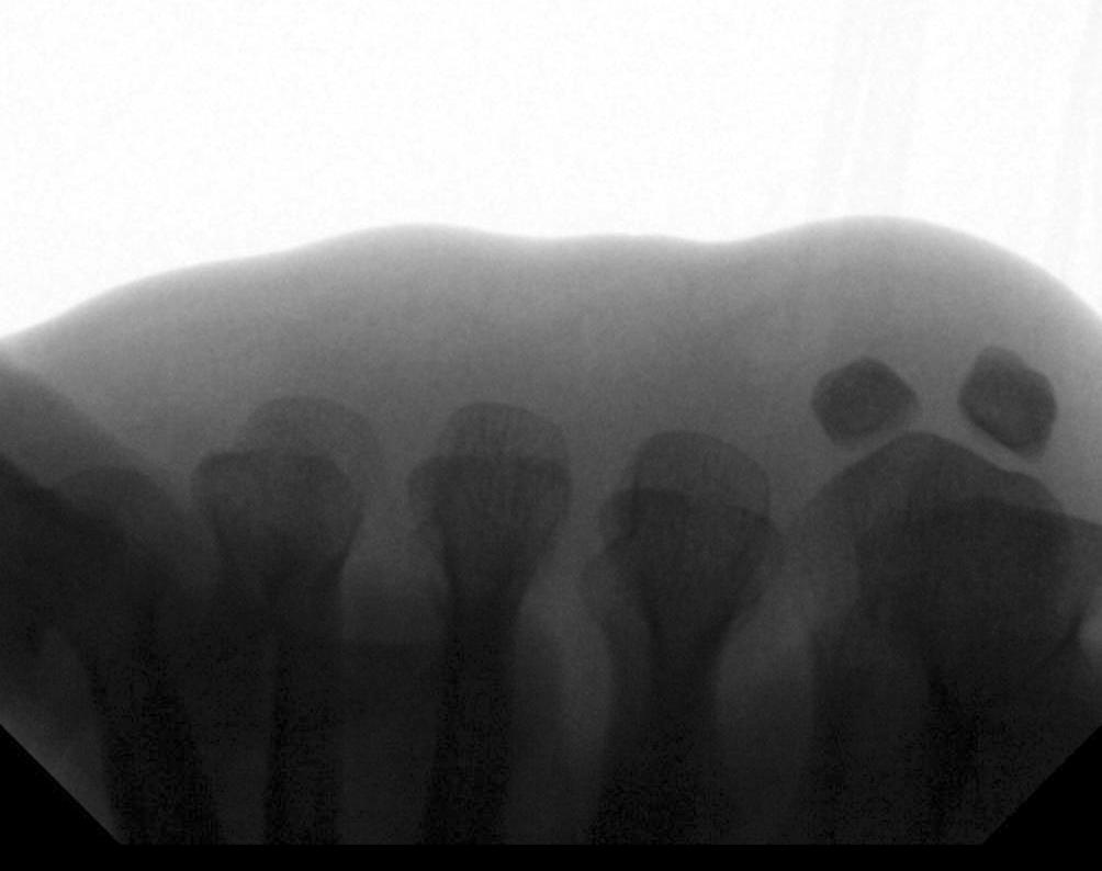 After the metatarsal corrective osteotomy, the length of 3rd metatarsal bone was shortened. 의 근력 저하가 6예(%)에서 관찰되었으나 6개월 추시관찰 시에 A B Figure 5. C-arm radiographs. (A) erative sesamoid view.