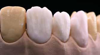 개별적인특성화은, 예를들어구개부에 Occlusal Dentin 을사용합니다.