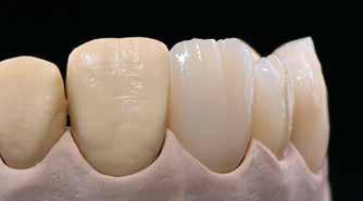 2 차 Dentin/Incisal 소성 수복물을마무리하고완전히세척합니다.