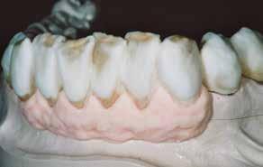 1 Gingiva G1 2 Gingiva G2 3