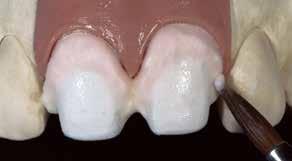 max Ceram Dentin이나 Transpa clear도사용될수있습니다. IPS e.