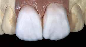 실제과정 추가적인가공기법 비니어 Veneer Dentin/Impulse 소성의소성변수는 66페이지를참조하십시오.