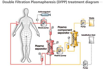 <Figure3. Plasma Exchange(PE) treatment diagram> https://www.asahi-kasei.co.jp/medical/en/personal/cure/cure_01.html <Figure 4. DFPP treatment diagram> https://www.asahi-kasei.co.jp/medical/en/personal/cure/cure_01.html 5 Bortezomib : 26s proteasome 복합체를선택적으로억제하는 proteasome 억제제이다.