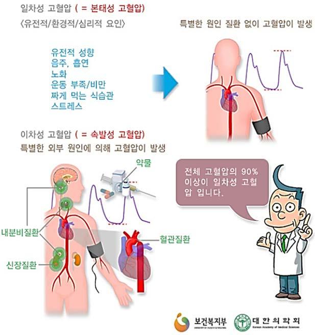 고혈압의종류로는크게일차성고혈압과이차성고혈압이있다. 신장이식으로인한고혈압은 2 차성고혈압이다.