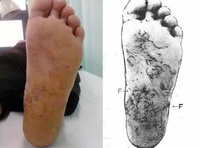 족저부의전반적인미란과두부위의큰균열이관찰된다 (F 표기부위 ). Fig.