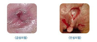 : 시진및촉진 치열 (anal fissure) 치료 :