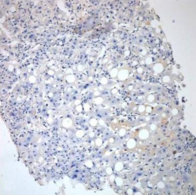 Hepatocyte dropout and necrosis is noted with pericellular fibrosis. Moderate fatty changes are seen.