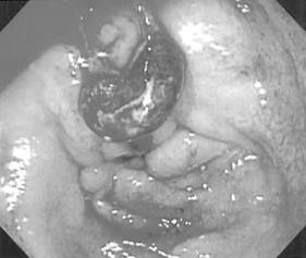 - 정승욱외 6 인 : Coil embolization 으로치유된십이지장 Dieulafoy 병변출혈 1 예 - Figure 1. Upper GI endoscopy shows 1.5 cm sized banana shaped Dieulafoy's lesion at duodenal bulb portion.