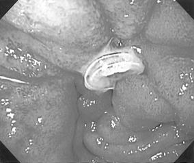 - 대한내과학회지 : 제 70 권부록 2 호 2006 - Figure 4. Follow up endoscopy shows edematous mucosa with protruded microcoil at previous Dieulafoy's lesion.