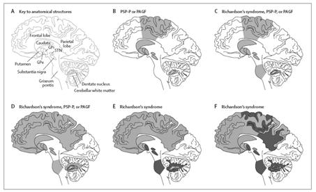 Tauopathies with Parkinsonism Progressive Suprnuclear Palsy Pseudobulbar palsy-weak voice, dysphagia Axial rigidity Cognitive impairment-inattentive, apathy, decreased word