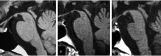 3.6-4.9 years after the onset of clinical signs.