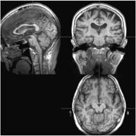 form Gait freezing, apraxia of speech with delayed or even absent core PSP feature DDx with PD More axial, dystonic, less tremor(10-20%), symmetric, retrocollis, scloliosis