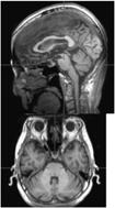 and medullary nuclei rimlf (premotor burst neurons) Cholinergic neurons of the lower pontine reticular formation Clinical features Dysexecutive syndrome; progressive