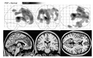 양동원 Progressive Suprnuclear Palsy FDG-PET SPM Corticobasal degeneration -clinical presentation Movement asymmetric!