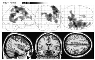 bilateral, imitation of meaningless hand gesture Alien limb-has a will of its won intermanual conflict Frontal releasing sign Dementia, aphasia(motor) Others Cortico-spinal tract sign Oculomotor