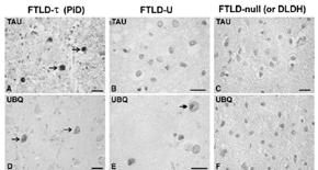 Tauopathies with Parkinsonism Frontotemporal dementia with parkinsonism linked to chromosome 17 FTD + parkinsonism First reported in 1994 Autosomal dominant, 100% penetrance Chromosome 17-MAPT or