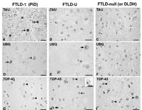 dementia Probable AD CBD FTDP 17-clinical presentation Age of onset between the third and fifth decades Neuropsychiatric syndrome including personality and behavioral abnormalities Parkinsonism-plus