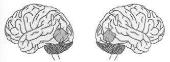 problem is not one of anomia per se Lesion areas Bilateral at the