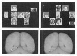 오은아 Failure of Object Recognition Prosopagnosia Selective inability to recognize or differentiate among faces, although other objects in the visual modality can be correctly identified Can recognize