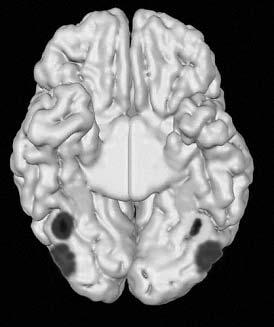 with disorders of visual recognition rather than of spatial cognition Spatial abilities are preserved Patients develop a heavy dependence on their preserved spatial abilities to find their way around