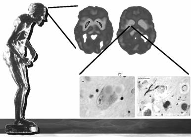 Aggregation Clearance Factors: Environments Genetic variations Aging Mitochondrial Function Diseases due to Degradation of Misfolded protein Diseases due to Accumulation of Misfolded protein Disease