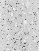 degeneration Spongiform Amyloid plaques (occasionally) HUMAN TSE TSE, Prion diseases in animals A.