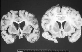 Fatal Familial Insomnia (FFI) C. IATROGENIC <1% (corneas, hgh, dural grafts) D. ORAL INGESTION 1.