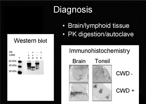 Bead Bead 안성수 BSE link to vcjd: WESTERN BLOT OF CJDs PK _ Normal Abnormal 1. SPORATIC CJD 2. GSS 3.