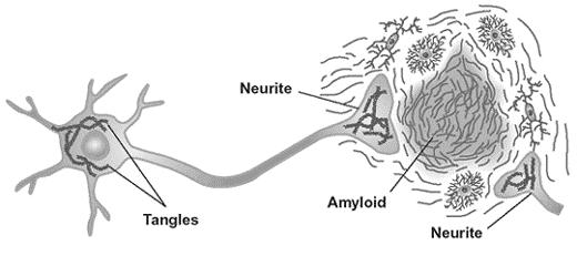 , 2000) Dissolution of Aβ aggregates by zinc chelators in vitro (Cherny et al.