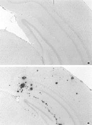 (iodochlorhydroxyquin) and PBT2 CQ-treated