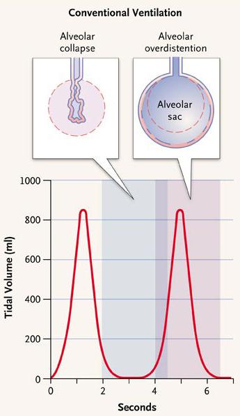 - Je Hyeong Kim. Ventilator-induced lung injury - A Figure 2. Conventional ventilation compared to protective ventilation in a 70-kg patient with ARDS.