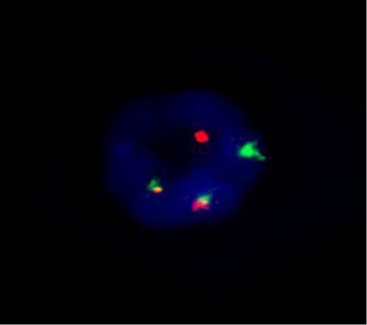 - Ju Hee Seo, et al. Biphenotypic acute leukemia with expression of AML1-ETO gene-rearrangement - Figure 2. Fluorescence in situ hybridization.