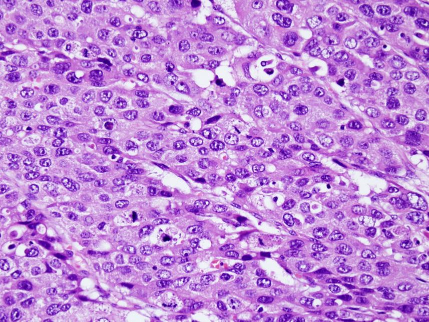 Jung Bin Yoon, et al: Clinicopathological Characteristics of GHA Fig. 2. Microscopic features of gastric hepatoid adenocarcinoma.