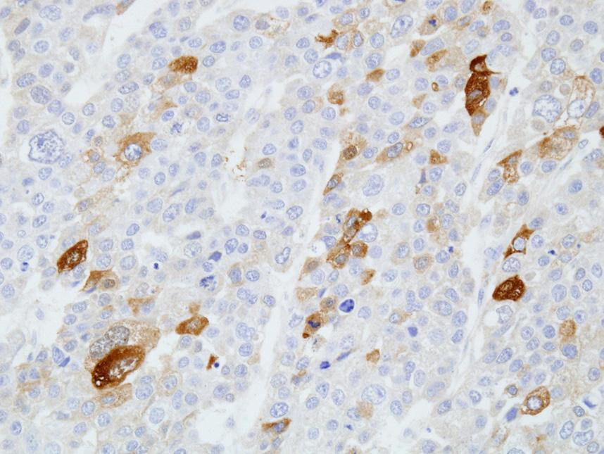 (B D) Alpha-fetoprotein, glypican 3 and hepatocyte specific antigen are positive in tumor cells, respectively (immunohistochemical stain, 400). Fig.