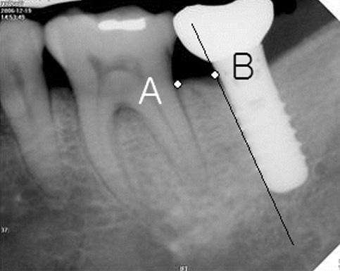 original article He Sung Shin et al: Complications Related to Cantilever Lengths in Implant- Supported Single Crowns.