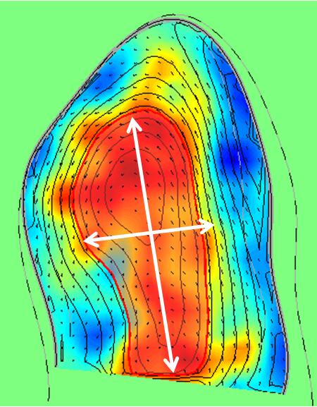 Fourier decomposition 기술하는 지표들로 VL는 전체 좌심실 길이에 비하여 vortex 을 이용하여 지표들을 산출하게 되는데, 첫 번째 Fourier harmonic 의 장축 거리를 VW는 장축에 수직하는