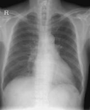 청진상거친호흡음이들렸고, 폐양측하부의호흡음은감소되었다. 또한 S3가심첨부에서청진되었다. 흉부 X선검사 ( 그림 1A) 상심비대와양측늑막삼출이관찰되었고, 심전도상동성빈맥이었으며 lead II, III, avf에서 Q파가관찰되었다.